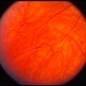 Peripheral retinal nonperfusion, venous beading and dilatation, retinal microaneurysms, and  intraretinal hemorrhage